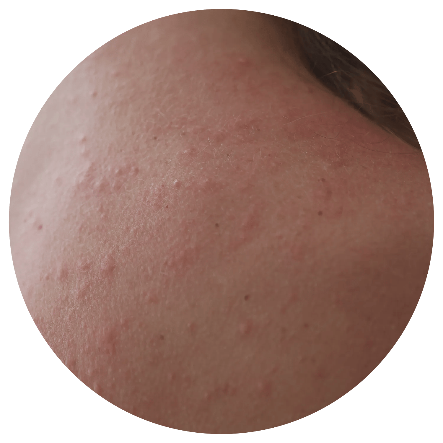 Back Acne treatment process at Toronto medical spa - The body's largest surface—reflecting what's happening inside.
